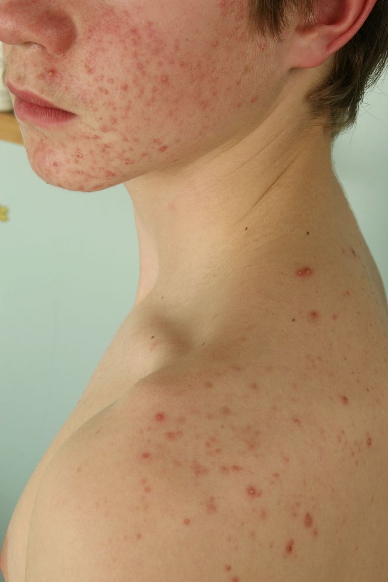 acne infiammatoria, dell acne, dell acne infiammatoria, trattamento dell acne