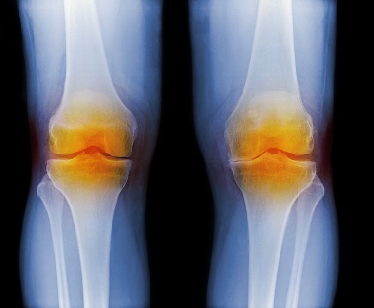 Artrite reumatoide, danno articolare, della cartilagine, della malattia, attività della