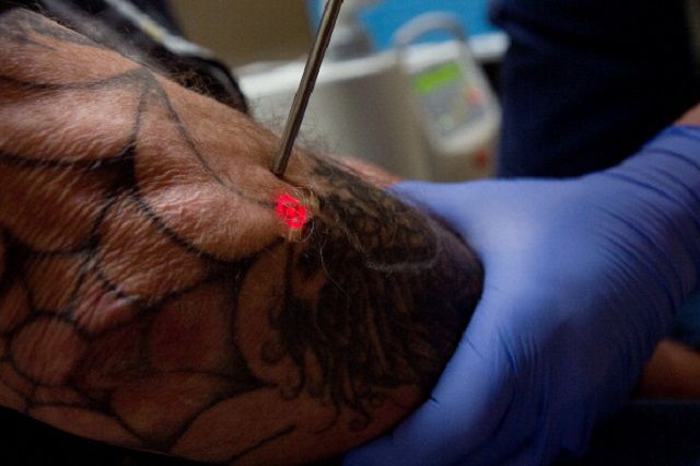 rimozione tatuaggio, tatuaggio laser, rimozione tatuaggio laser, sulla rimozione, sulla rimozione tatuaggio, altri metodi