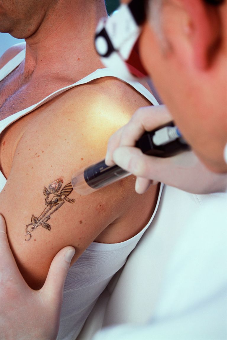 rimozione tatuaggio, altre opzioni, colori laser, laser Quando, rimozione tatuaggio laser