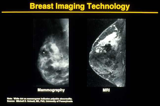 cancro seno, mammario denso, tessuto mammario, tessuto mammario denso, risonanza magnetica