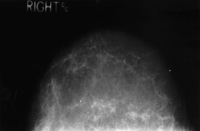 cancro seno, mammario denso, tessuto mammario, tessuto mammario denso, risonanza magnetica
