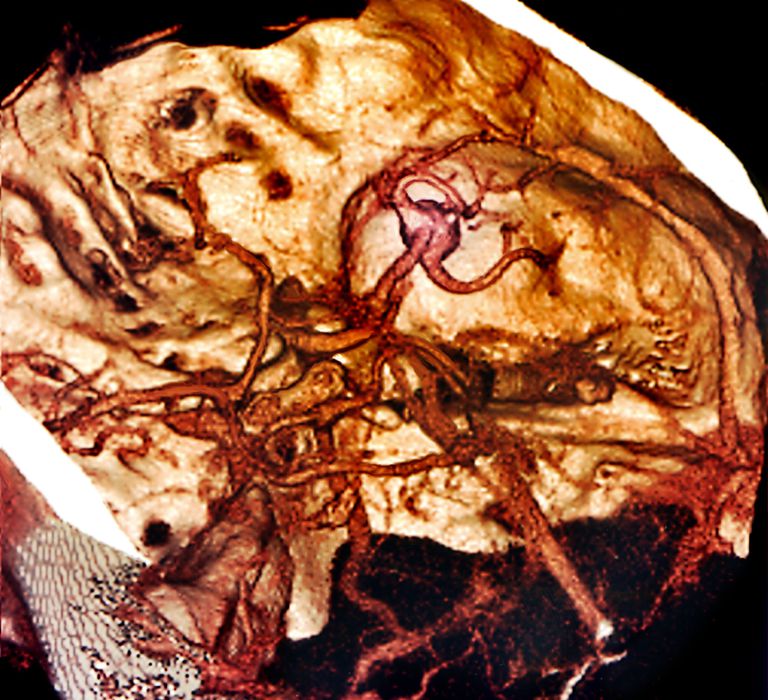 arteria cerebrale, cerebrale media, arteria cerebrale media, vaso sanguigno, colpo arteria, colpo arteria cerebrale