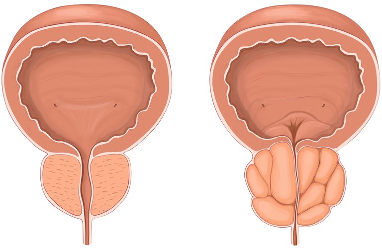 sistema Rezūm®, ghiandola prostatica, della prostata, alla prostata