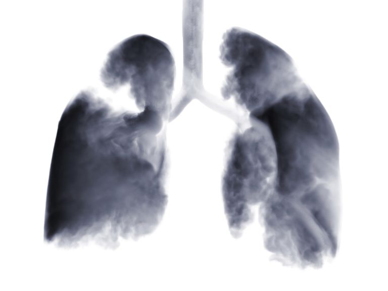 piccole cellule, tumori polmonari, polmonari piccole, polmonari piccole cellule, tumori polmonari piccole, cancro polmoni