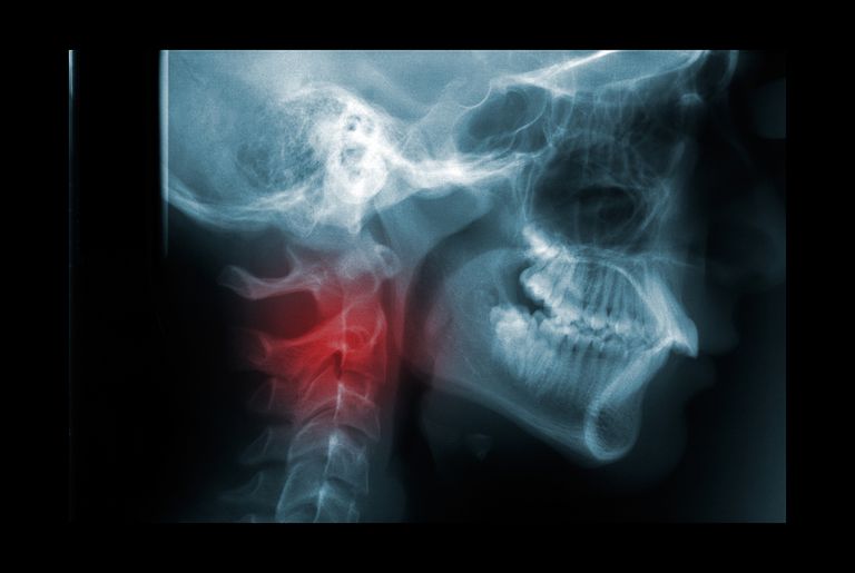colonna vertebrale, midollo spinale, colpo frusta, della colonna
