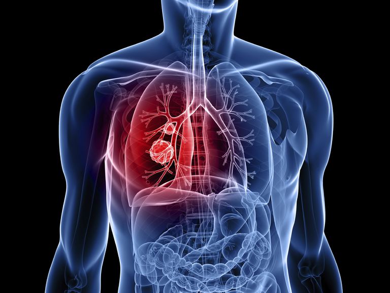cancro polmone, piccole cellule, cancro polmoni, carcinoma polmonare