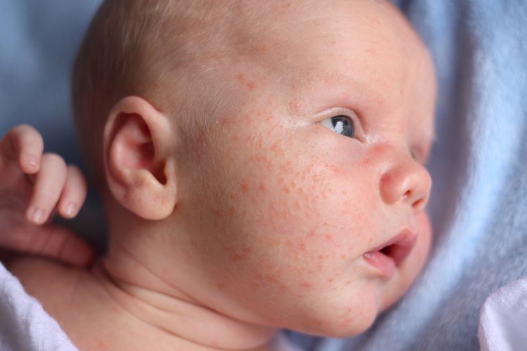 acne infantile, acne bambino, dell acne, maggior parte