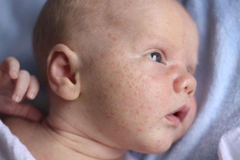 acne bambino, acne neonatale, acne neonata, acne infantile, dell acne, eruzione cutanea