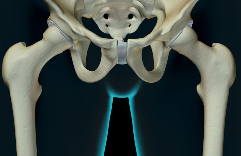 dell anca, displasia dell, displasia dell anca, articolazione dell, articolazione dell anca, dell articolazione