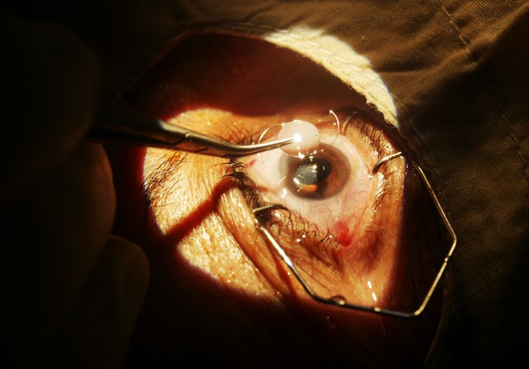 chirurgia della, chirurgia della cataratta, della cataratta, dell occhio, anestesia locale