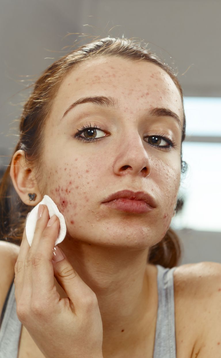 dell acne, trattamento dell, trattamento dell acne, contro acne, della pelle