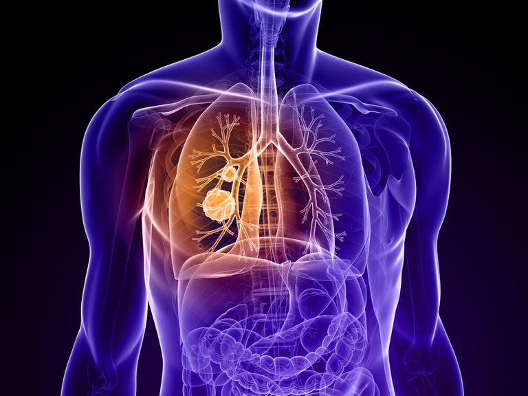 massa polmonare, cancro polmoni, cancro polmone, nodulo polmonare