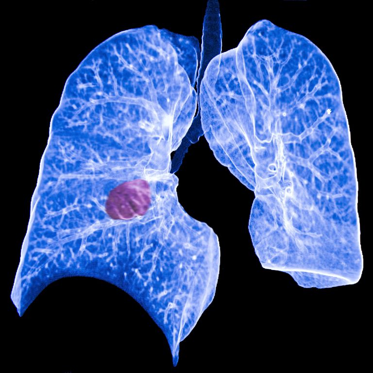 polmonare primario, cancro polmone, cancro polmoni, tumore polmonare, secondo tumore