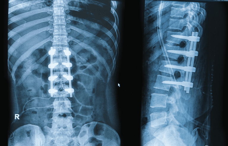fusione spinale, colonna vertebrale, intervento chirurgico, innesto osseo, chirurgico revisione
