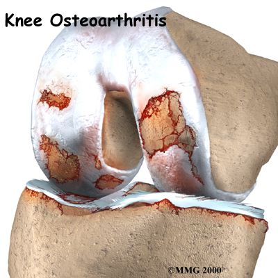 artrosi ginocchio, linee guida, questi trattamenti, dell osteoartrosi, dell osteoartrosi ginocchio, osteoartrosi ginocchio