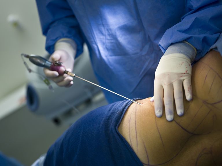 paziente sarà, dopo procedura, indumento compressione, procedura paziente, aree corpo