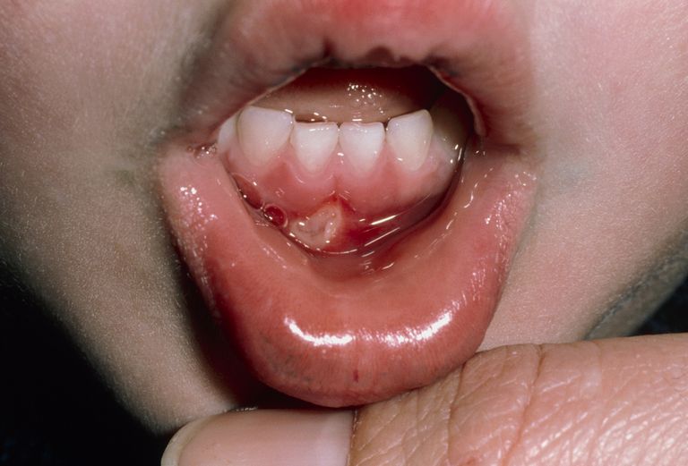 della bocca, ulcere orali, stomatite aftosa, ulcere della