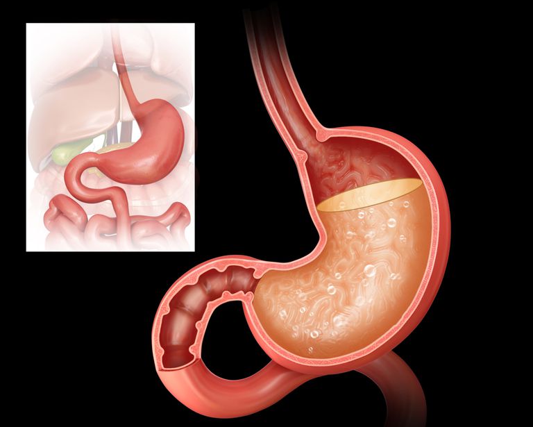dello stomaco, contenuto dello, contenuto dello stomaco, dallo stomaco, nell esofago