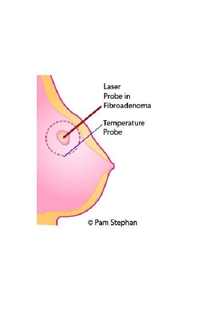 ablazione laser, forma seno, terapia ablazione, terapia ablazione laser, ablazione laser tumori, anestesia generale