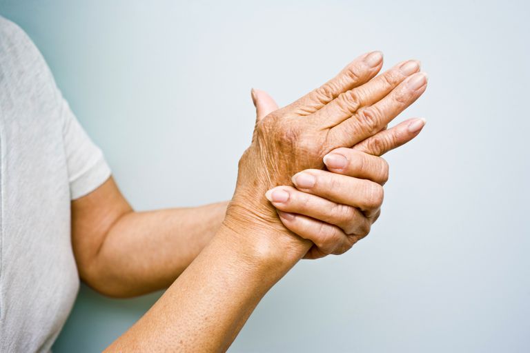 Artrite reumatoide, dell artrite