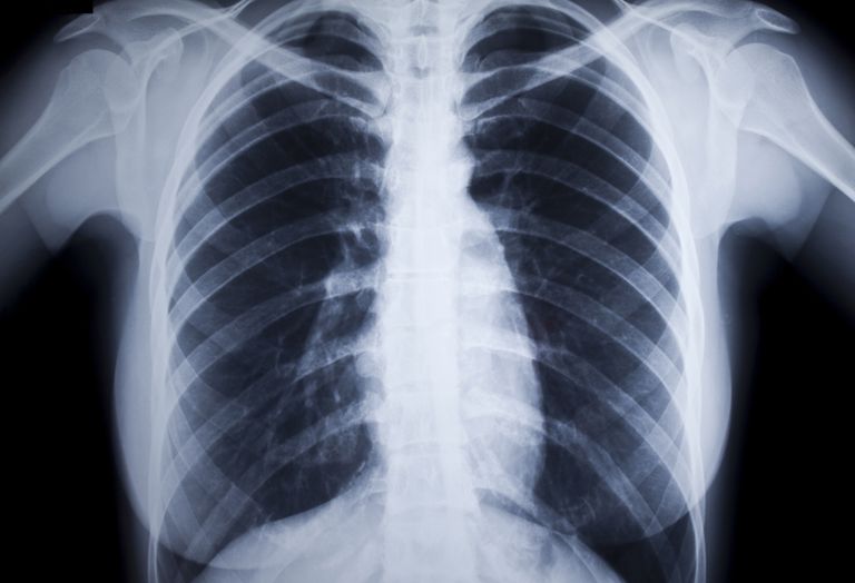 malattia polmonare, Artrite reumatoide, polmonare reumatoide, malattia polmonare reumatoide, polmonare interstiziale