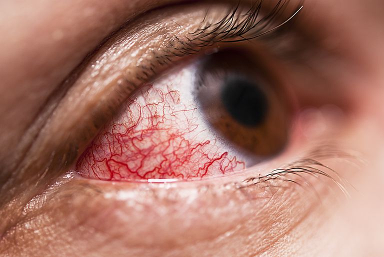 dell occhio, della sclera, della vista, sclerite anteriore, sclerite necrotizzante, anteriore della