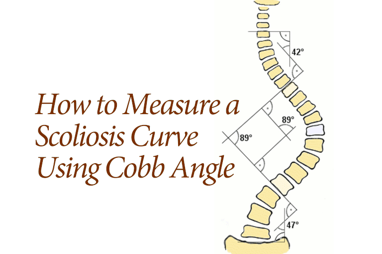 angolo Cobb, vertebra apicale, della curva, della vertebra, lungo bordo, allo stesso