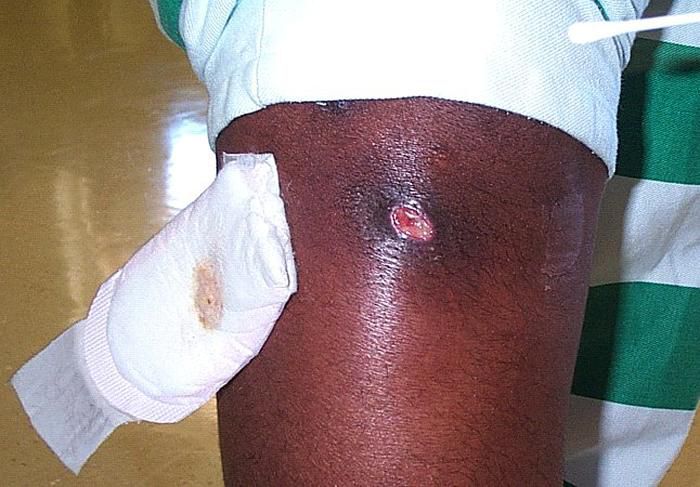 infezioni MRSA, della pelle, alla meticillina, come MRSA