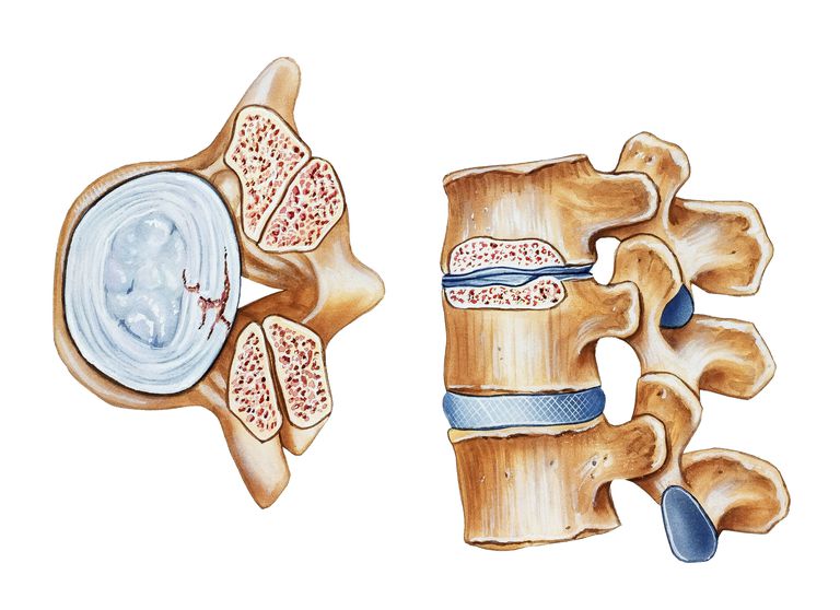 stenosi spinale, colonna vertebrale, canale spinale, alle gambe, della colonna, della colonna vertebrale