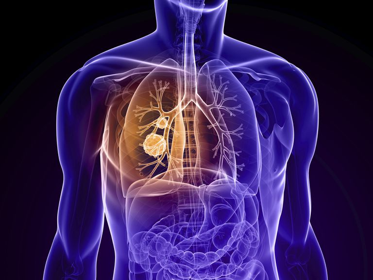 cancro polmone, carcinoma polmonare, dello stadio, allo stadio, cancro polmoni, polmonare allo