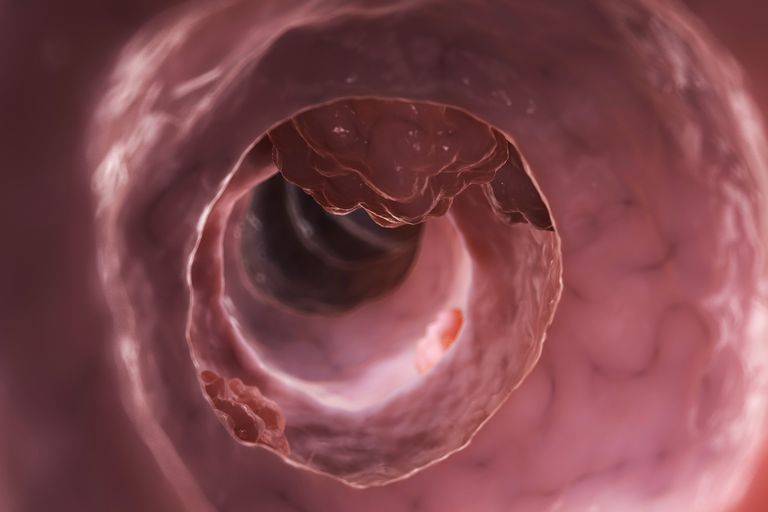 cancro colon, colon stadio, cancro colon stadio, linfonodi vicini, parete intestinale