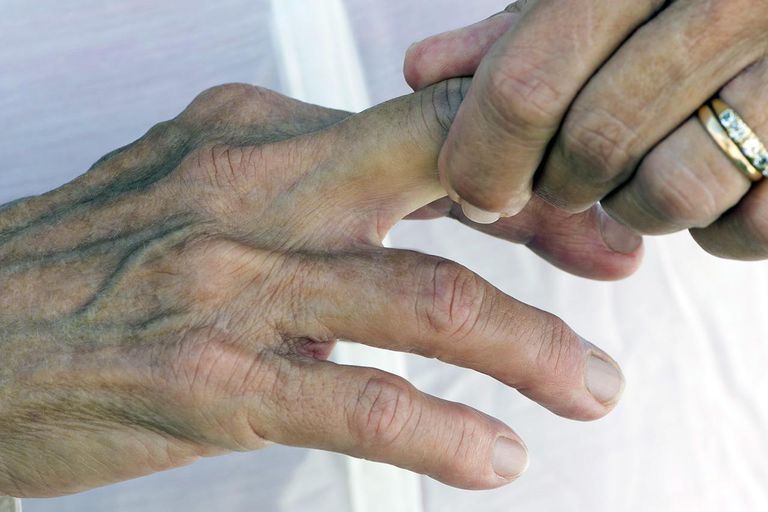 delle dita, dito inceppato, dita inceppate, dito curativo, chiropratico osteopata