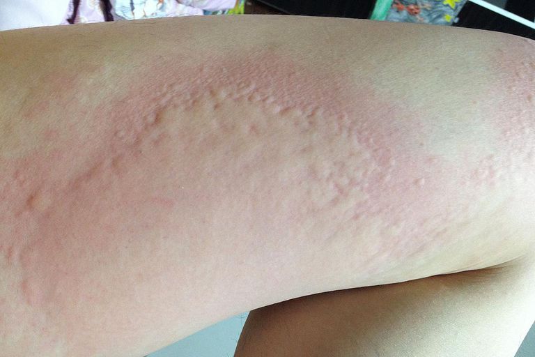 allergia sulfa, causare allergia, usato trattare, allergia alfa