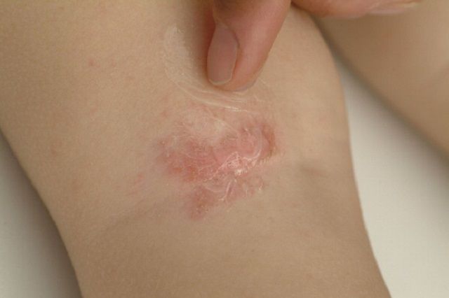 eruzione cutanea, dell eczema, della pelle, come dermatite, eczema testardo, eruzioni cutanee