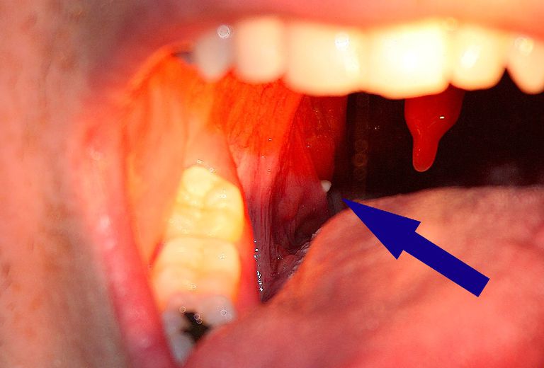 calcoli tonsillari, delle pietre, delle tonsille, pietre tonsillari, delle pietre tonsillari
