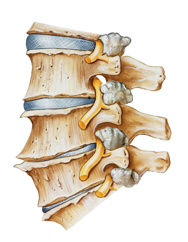 della trazione, speroni trazione, colonna vertebrale, disco intervertebrale, piastra terminale, colonna lombare