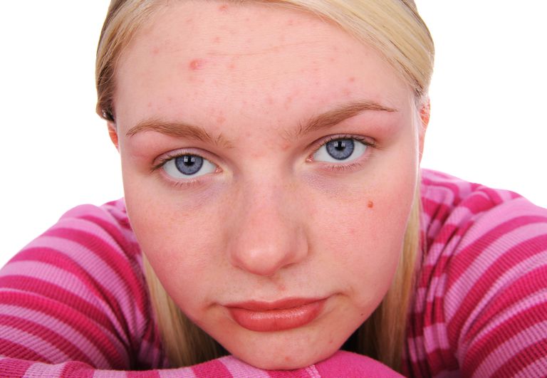 acne lieve, lieve acne, dell acne, punti neri, sulla pelle, trattamento acne