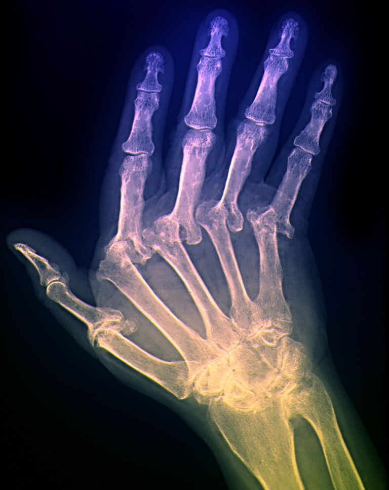 deriva ulnare, deviazione ulnare, Artrite reumatoide, della mano, delle articolazioni