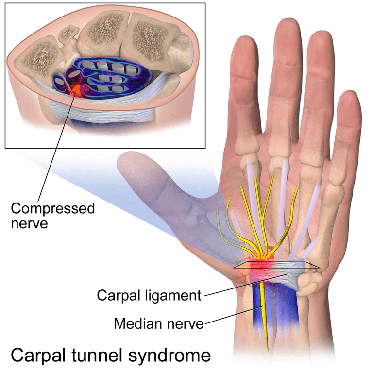 tunnel carpale, sindrome tunnel, sindrome tunnel carpale, della sindrome