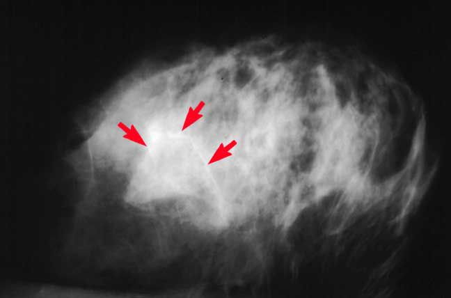 calcificazioni seno, cancro seno, delle calcificazioni, sulla mammografia