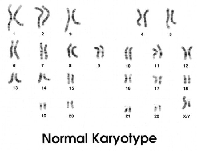 sindrome Down, condizione causata, cromosomi sono, parte cromosoma, problema genetico, secondo National