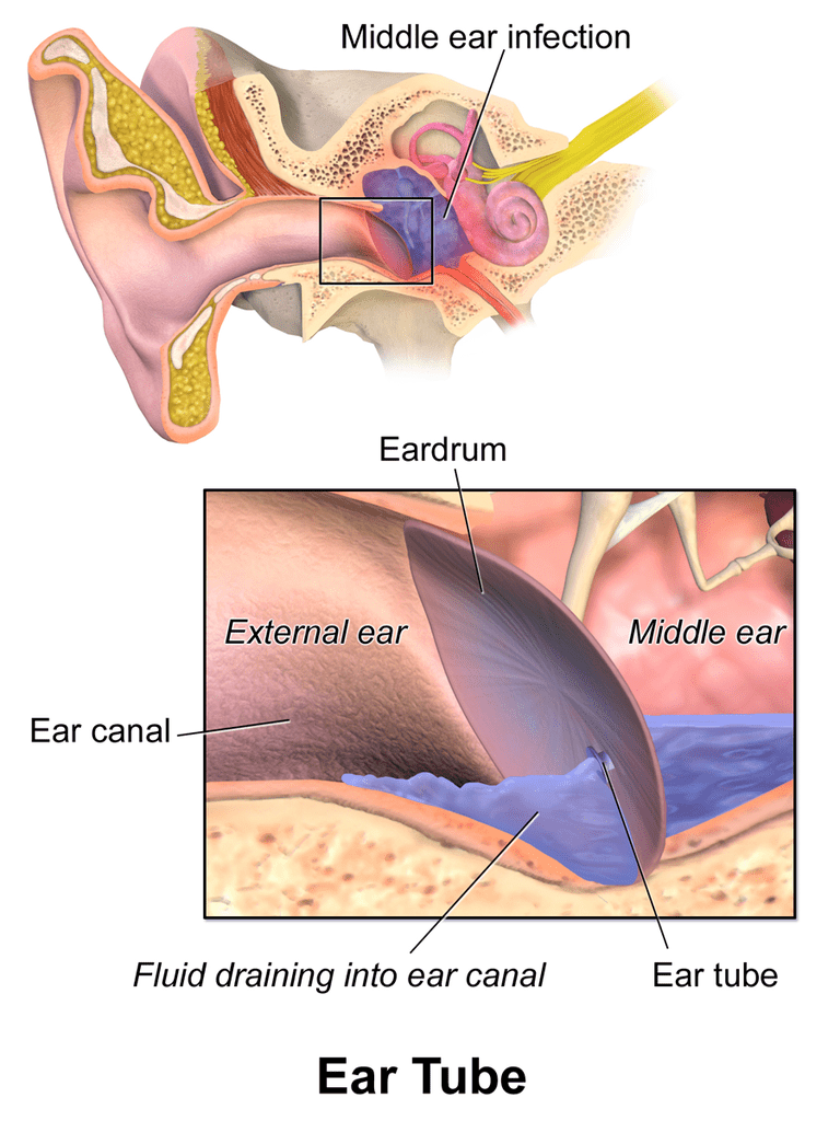 nell orecchio, tubi ventilazione, orecchio medio, dell orecchio, fluido nell
