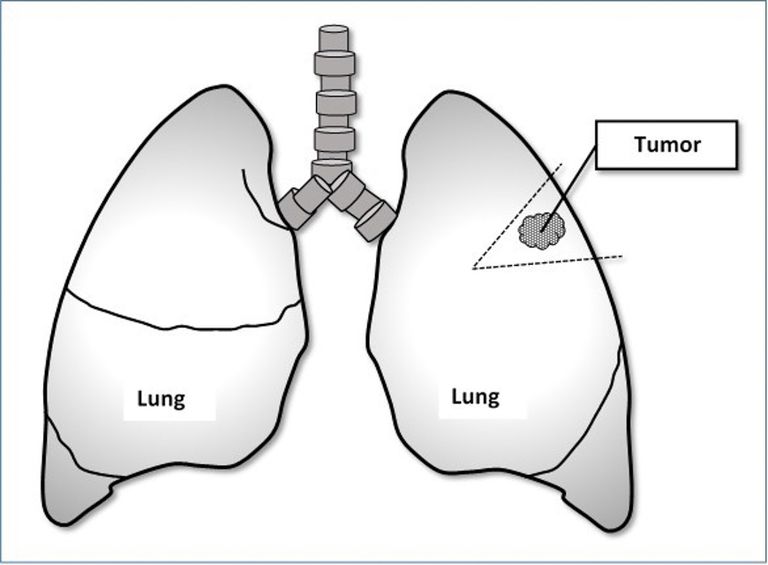 resezione cuneo, cancro polmone, cancro polmoni