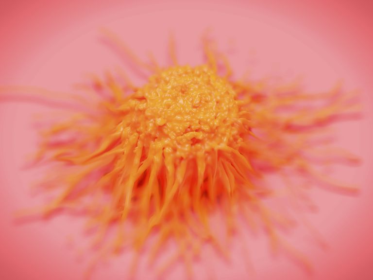 cellule Sertoli-Leydig, dell ovaio, delle cellule, tumori delle