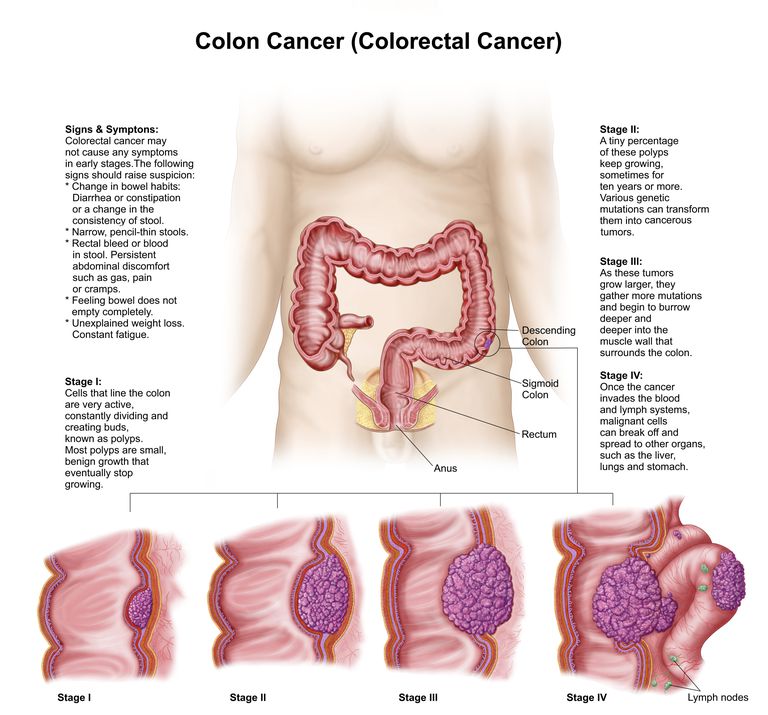 cancro colon, parete colon, attraverso strato, cancro colon-retto