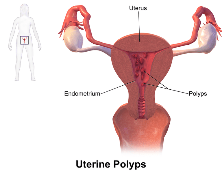polipi uterini, nell utero, polipi uterini sono, sintomi polipi