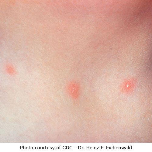 dell herpes, infezione herpes, herpes genitale, herpes simplex, immagine mostra, Questa immagine mostra