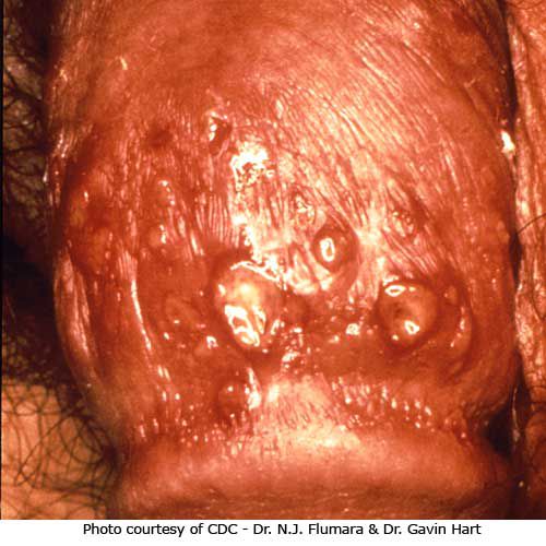 dell herpes, infezione herpes, herpes genitale, herpes simplex, immagine mostra, Questa immagine mostra