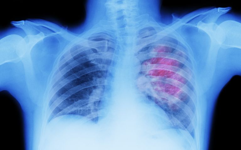 cancro polmoni, dell anestesia, della procedura, altre condizioni, cancro polmone